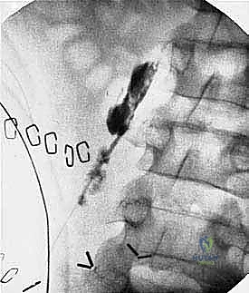 صورة طبية: بتر الفخذ فوق الركبة الأورامي: دليل شامل للمرضى وخبرة الأستاذ الدكتور محمد هطيف