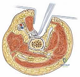 استخدام التقنيات الميكروسكوبية في الجراحة