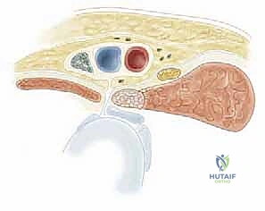 الخيارات العلاجية لتشنجات الورك
