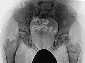 نتائج الجراحة وتحسن المشي لدى الأطفال