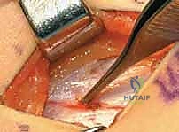 التخطيط الجراحي الدقيق