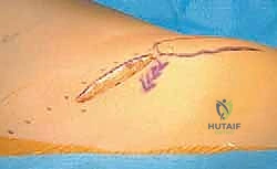 تشنجات الورك لدى الأطفال: دليل شامل لإطالة العضلة الحرقفية القطنية والعضلات المقربة مع الأستاذ الدكتور محمد هطيف