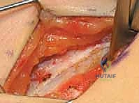 خطوات جراحة إطالة الأوتار