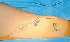 العضلة الحرقفية القطنية والعضلات المقربة