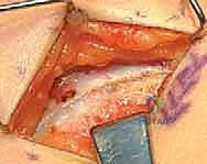 الفحص السريري لتشنجات الورك