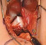 Illustration of adductor and iliopsoas - Dr. Mohammed Hutaif