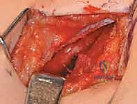 الدقة في تحرير العضلات المقربة