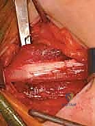 إطالة العضلة الحرقفية القطنية بأمان