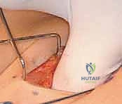 العناية ما بعد الجراحة والتجبير