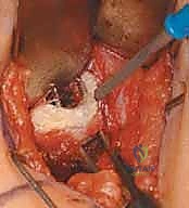 التشريح الدقيق لمفصل الورك