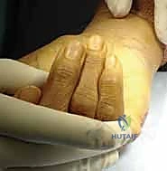 Corrective Osteotomy for Metacarpal and Phalangeal Malunion: An Intraoperative Masterclass