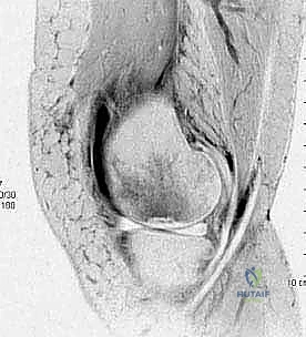 صورة توضيحية لـ الآفات العظمية الغضروفية في الركبة: دليل شامل لعلاج OCD والنخر اللاوعائي مع الأستاذ الدكتور محمد هطيف في صنعاء