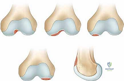 النخر اللاوعائي في الركبة