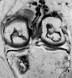 صورة الرنين المغناطيسي توضح الآفة