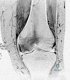 النخر العظمي التلقائي SONK