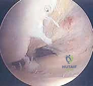 صورة توضيحية لـ الآفات العظمية الغضروفية في الركبة