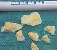 مراحل التهاب العظم والغضروف السالخ