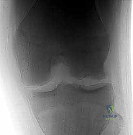 الآفات العظمية الغضروفية في الركبة: دليل شامل لعلاج OCD والنخر اللاوعائي مع الأستاذ الدكتور محمد هطيف في صنعاء