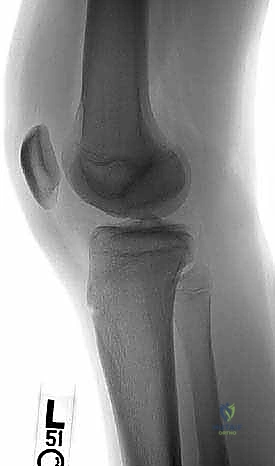 الخيارات الجراحية للآفات العظمية الغضروفية