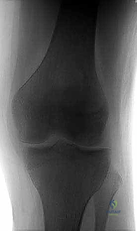 صورة طبية: الآفات العظمية الغضروفية في الركبة: دليل شامل لعلاج OCD والنخر اللاوعائي مع الأستاذ الدكتور محمد هطيف في صنعاء