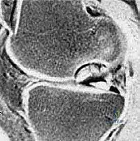 صورة طبية: الآفات العظمية الغضروفية في الركبة: دليل شامل لعلاج OCD والنخر اللاوعائي مع الأستاذ الدكتور محمد هطيف في صنعاء