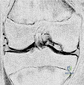 صورة توضيحية لـ الآفات العظمية الغضروفية في الركبة: دليل شامل لعلاج OCD والنخر اللاوعائي مع الأستاذ الدكتور محمد هطيف في صنعاء