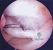 صورة توضيحية لـ الآفات العظمية الغضروفية في الركبة: دليل شامل لعلاج OCD والنخر اللاوعائي مع الأستاذ الدكتور محمد هطيف في صنعاء