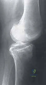 صورة طبية: الآفات العظمية الغضروفية في الركبة: دليل شامل لعلاج OCD والنخر اللاوعائي مع الأستاذ الدكتور محمد هطيف في صنعاء