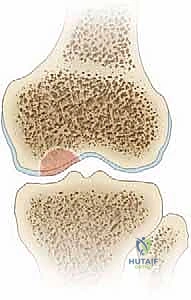 صورة طبية: الآفات العظمية الغضروفية في الركبة: دليل شامل لعلاج OCD والنخر اللاوعائي مع الأستاذ الدكتور محمد هطيف في صنعاء