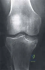 صورة طبية: الآفات العظمية الغضروفية في الركبة: دليل شامل لعلاج OCD والنخر اللاوعائي مع الأستاذ الدكتور محمد هطيف في صنعاء