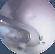 صورة توضيحية لـ الآفات العظمية الغضروفية في الركبة: دليل شامل لعلاج OCD والنخر اللاوعائي مع الأستاذ الدكتور محمد هطيف في صنعاء