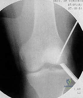 صورة توضيحية لـ الآفات العظمية الغضروفية في الركبة: دليل شامل لعلاج OCD والنخر اللاوعائي مع الأستاذ الدكتور محمد هطيف في صنعاء