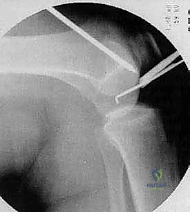 صورة طبية: الآفات العظمية الغضروفية في الركبة: دليل شامل لعلاج OCD والنخر اللاوعائي مع الأستاذ الدكتور محمد هطيف في صنعاء