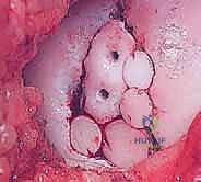 صورة طبية: الآفات العظمية الغضروفية في الركبة: دليل شامل لعلاج OCD والنخر اللاوعائي مع الأستاذ الدكتور محمد هطيف في صنعاء