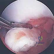 صورة طبية: الآفات العظمية الغضروفية في الركبة: دليل شامل لعلاج OCD والنخر اللاوعائي مع الأستاذ الدكتور محمد هطيف في صنعاء