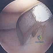 Knee Osteochondral Lesions: An Intraoperative Masterclass in OCD & AVN Management