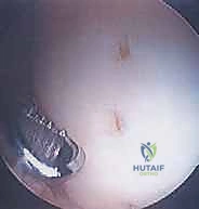 صورة توضيحية لـ الآفات العظمية الغضروفية في الركبة: دليل شامل لعلاج OCD والنخر اللاوعائي مع الأستاذ الدكتور محمد هطيف في صنعاء