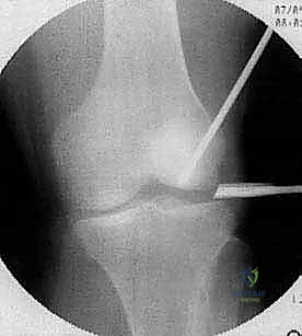 صورة طبية: الآفات العظمية الغضروفية في الركبة: دليل شامل لعلاج OCD والنخر اللاوعائي مع الأستاذ الدكتور محمد هطيف في صنعاء