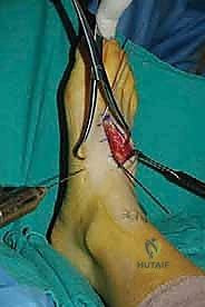 تثبيت مفصل رسغ القدم المشطي: الحل المتقدم لآلام منتصف القدم المزمنة مع الأستاذ الدكتور محمد هطيف