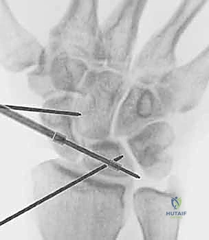 Arthroscopic Masterclass: Evaluation and Treatment of Scapholunate and Lunotriquetral Ligament Disruptions