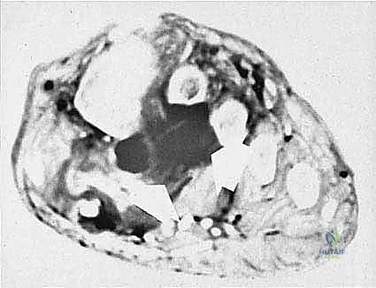 تأثير الأورام الخبيثة على عظام الساق