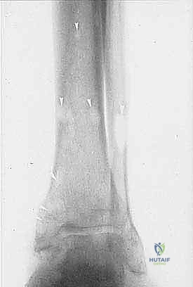 صورة توضيحية لـ بتر ما تحت الركبة لعلاج أورام الأطراف السفلية المعقدة دليل شامل للمرضى