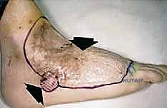 التشخيص الدقيق لأورام الأطراف السفلية