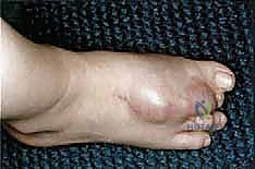 التحضير النفسي والطبي قبل عملية البتر