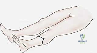 خطوات جراحة بتر ما تحت الركبة