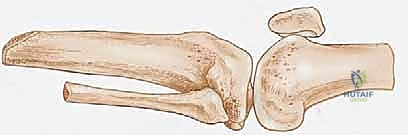 التعامل مع الأنسجة والعظام أثناء البتر