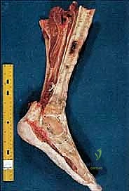 مراحل التأهيل والعلاج الطبيعي