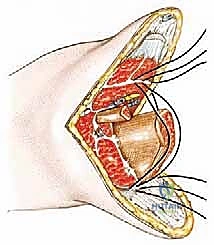 بتر ما تحت الركبة لعلاج أورام الأطراف السفلية المعقدة دليل شامل للمرضى