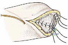 Mastering Below-Knee Amputation: An Intraoperative Masterclass for Complex Lower Extremity Tumors