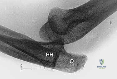 صورة رنين مغناطيسي توضح التمزق